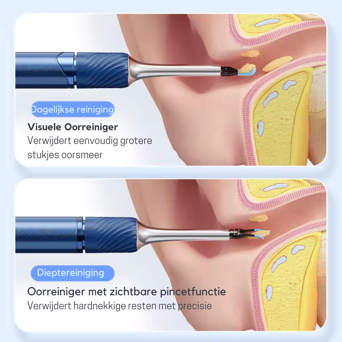 Slimme Oorreiniger met Camera